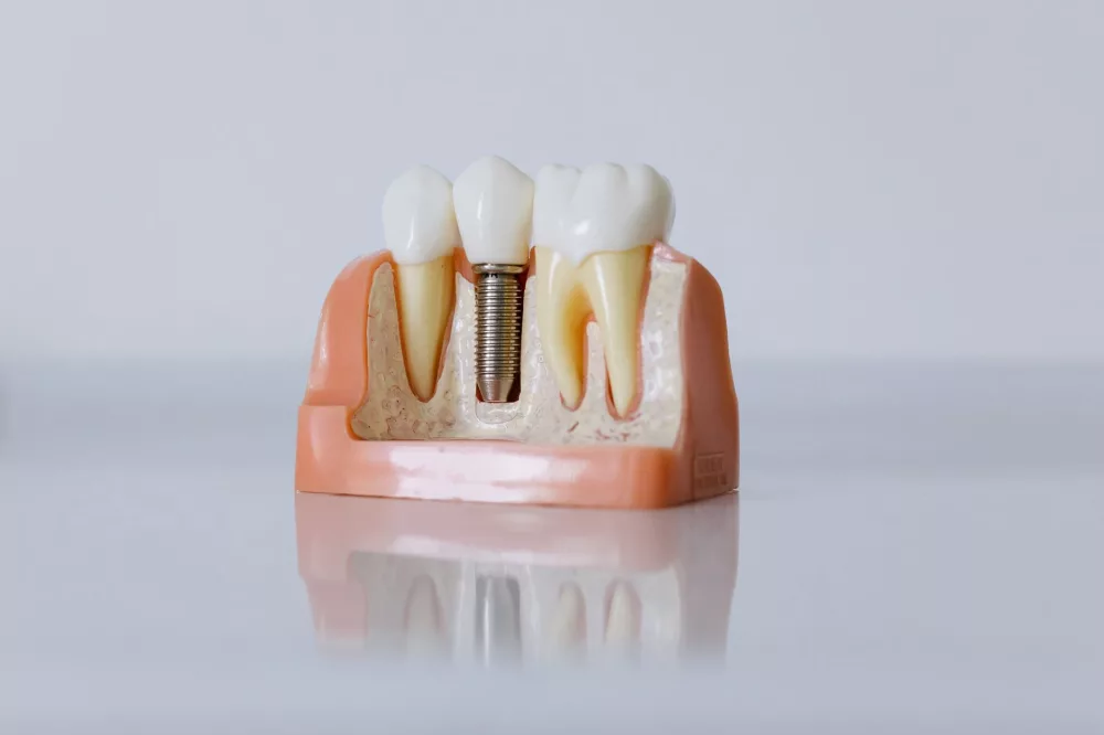 Clear Choice Dental: Unpacking the Integrated Approach to Full-Arch Restorations